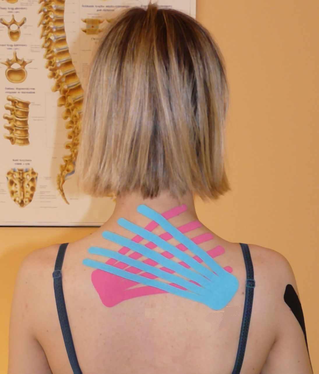 kinesiology taping